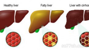 ما هو علاج تليف الكبد
