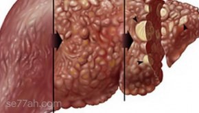 مراحل تليف الكبد