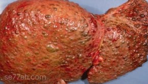 ما هو تليف الكبد
