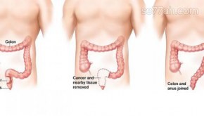 ما هي عوارض سرطان القولون