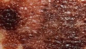 ما هو سرطان الجلد