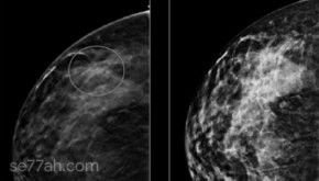 كيف اكتشف مرض سرطان الثدي