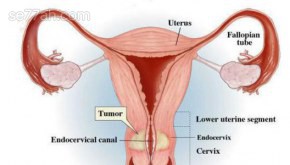 أسباب سرطان عنق الرحم