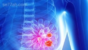 أعراض سرطان الثدي المبكرة