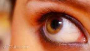 ما هو علاج ظفرة العين