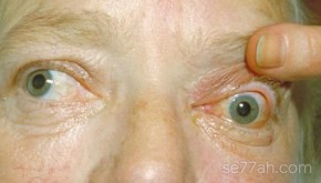 علاج جحوظ العين
