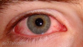 أمراض العيون وكيفية الوقاية منها