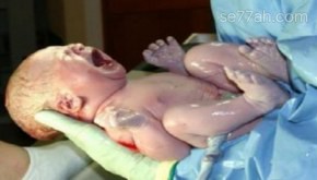 أسباب الولادة القيصرية