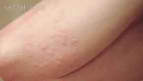 ما هي أعراض الطفح الجلدي