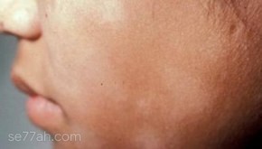 علاج الفطريات في الوجه