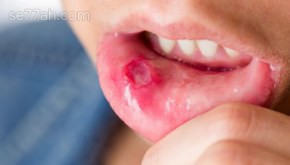 ما هي أنواع قرحة الفم