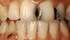تعريف تسوس الأسنان