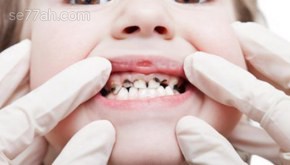 ما هو سبب تسوس الأسنان