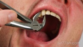 طريقة خلع الأسنان