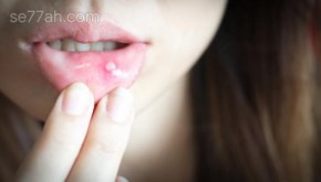 كيفية علاج قرحة الفم