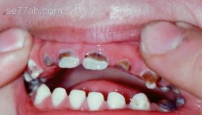 مراحل تسوس الأسنان