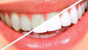 طريقة لإزالة الجير من الأسنان