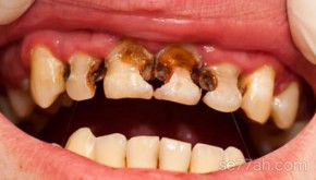 كيف تتخلص من تسوس الاسنان