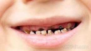 كيف يحدث تسوس الأسنان