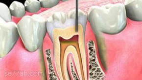 علاج عصب الأسنان في البيت