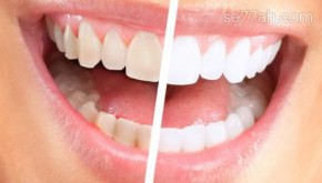 كيفية إزالة الجير من الأسنان
