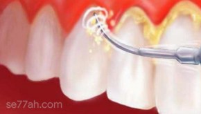 إزالة الجير من الأسنان بطرق طبيعية