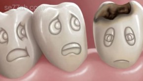 أسباب تسوس الأسنان