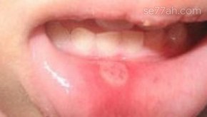 أسباب فطريات الفم