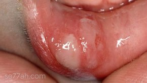كيف أعالج فطريات الفم
