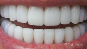 كم عدد الأسنان في فم الإنسان