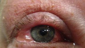 مرض ملتحمة العين