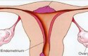 ما هي أعراض جرثومة الرحم