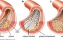 ما هو تعريف القسطرة القلبية