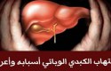 ما هو مرض الوباء الكبدي