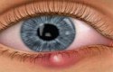 ما هي أسباب حساسية العين