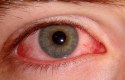 أمراض العين وكيفية الوقاية منها