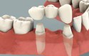 ما هو جسر الأسنان