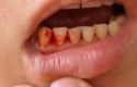 أسباب خروج الدم من الفم