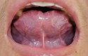 ما هو علاج تقرحات الفم