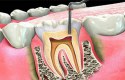علاج التهاب عصب الأسنان