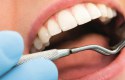 علاج عصب الأسنان
