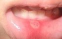 أسباب فطريات الفم