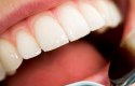 كيفية إزالة التسوس من الأسنان