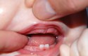 مراحل ظهور الأسنان