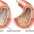 ما هو تعريف القسطرة القلبية