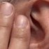 ما هو علاج صفير الأذن
