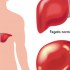 أعراض مرض الكبد