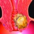 سرطان عنق الرحم أعراضه