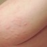 ما هي أعراض الطفح الجلدي