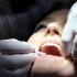 كيف أزيل تأثير بنج الأسنان